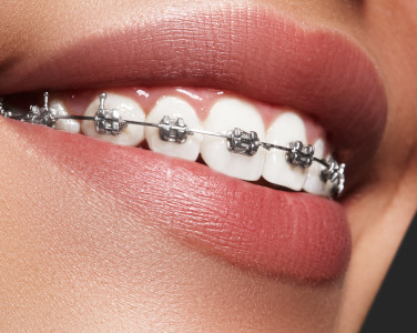 Benefits of Traditional Braces