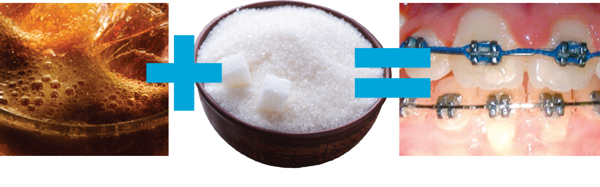 soda sugar braces