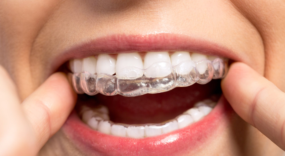 Adult Invisalign Clear Aligners